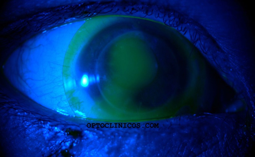 DIAGNÓSTICO CON LENTES DE&nbsp;CONTACTO