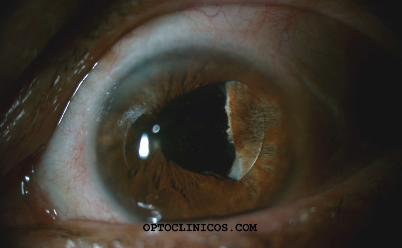 LIO CON TENDENCIA A&nbsp;LUXACIÓN