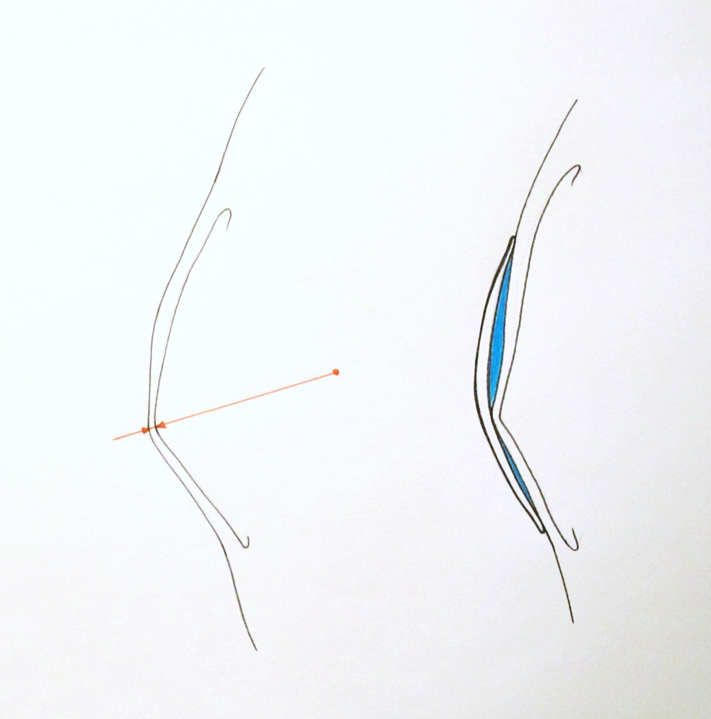TEMA 2 - PERFIL DE QUERATOCONO SIN Y CON LC RPG CORNEAL
