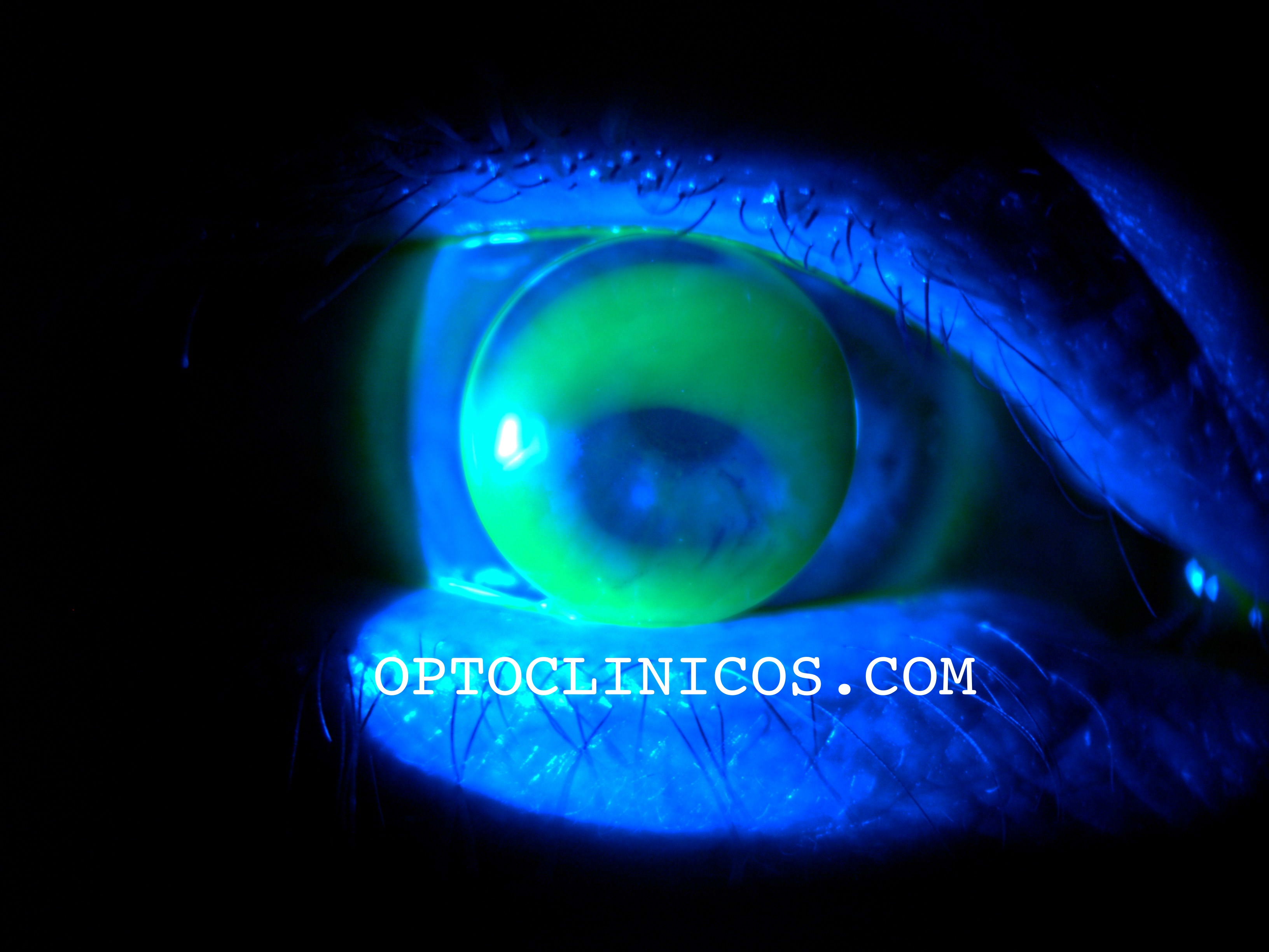 TEMA 6 - FLUOROGRAMA LC RPG CORNEAL ABIERTA