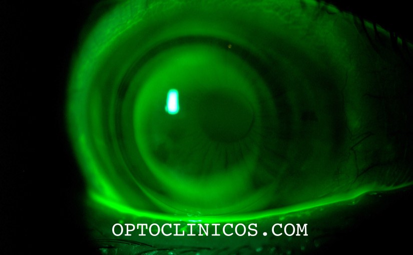 QUERATOCONO ¿PERO ESTO ES O NO ES UN&nbsp;QUERATOCONO?