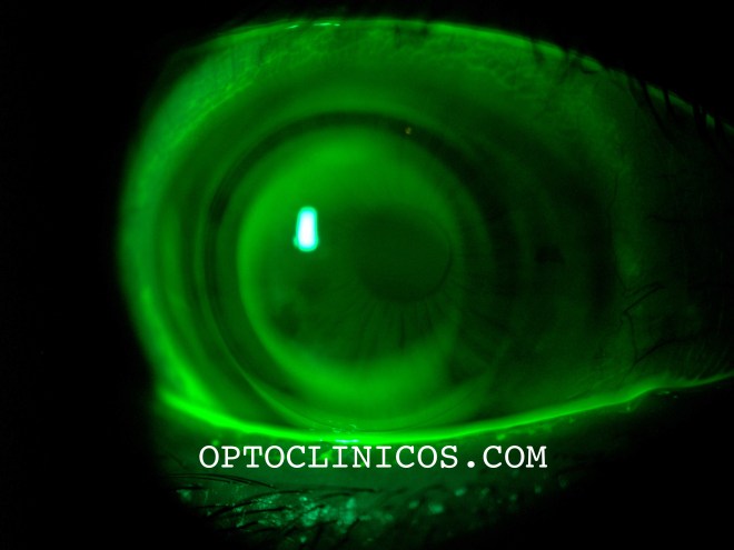 TEMA 6 - FLUOROGRAMA LENTE ESCLERAL