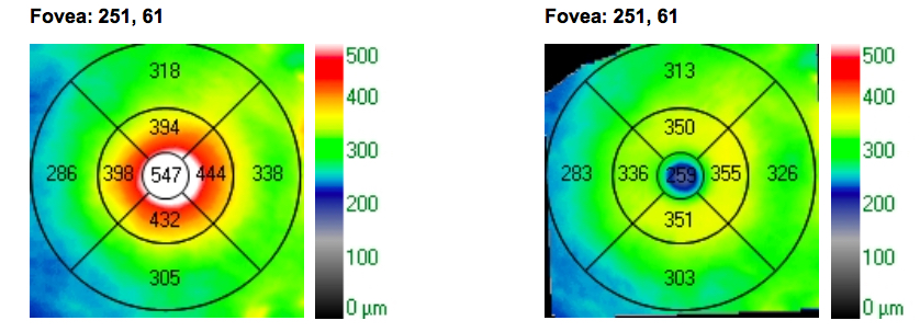 comparación central preo y post irvine gass