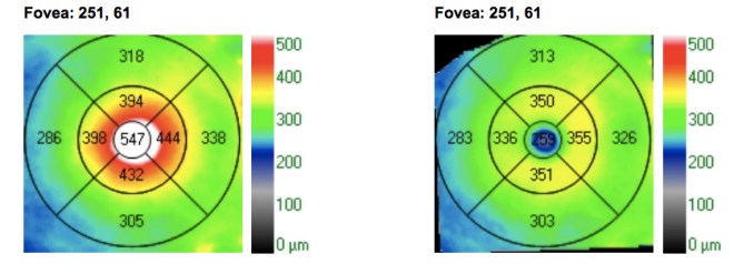 comparación central preo y post irvine gass
