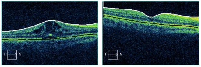 comparacion pre y post tto irvine gass