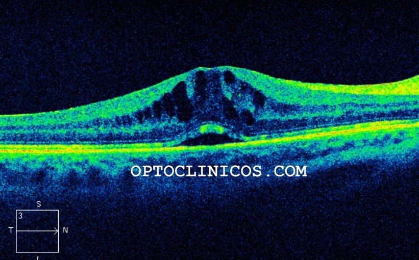 SÍNDROME DE IRVINE&nbsp;GASS