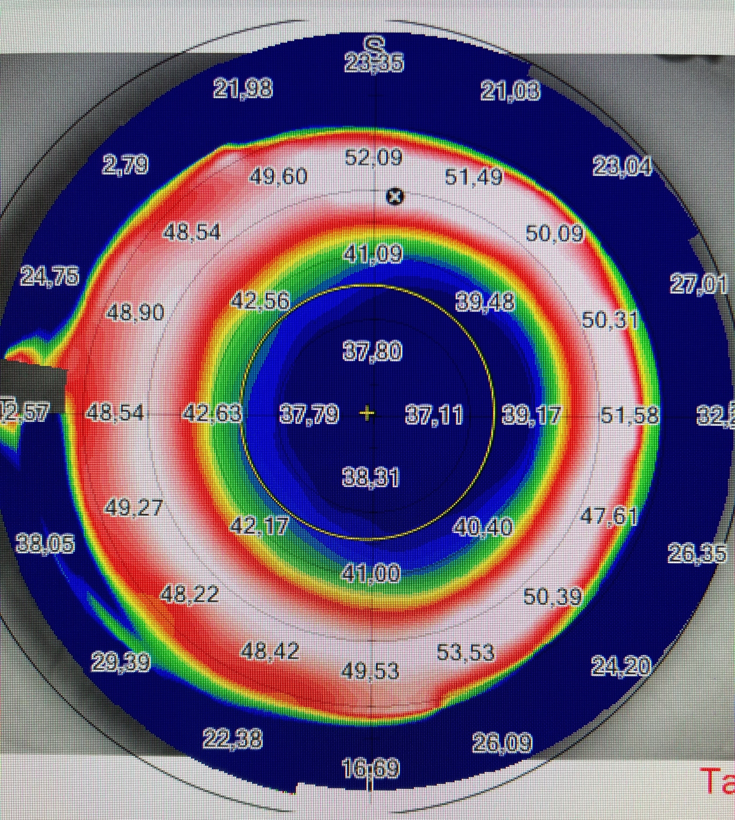 TEMA 5 - POST LASIK MIÓPICO