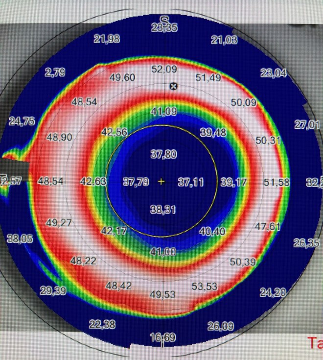 TEMA 5 - POST LASIK MIÓPICO