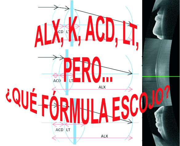 Cálculo de lentes intraoculares para todos. (Actualizándose a&nbsp;2024).